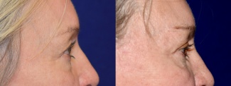 Right Profile View - Eyelid Surgery