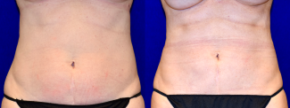 Frontal View - Liposuction