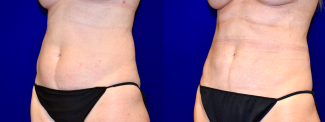 Left 3/4 View - Liposuction