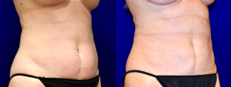 Right 3/4 View - Liposuction