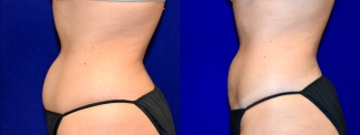 Left Profile View -Liposuction
