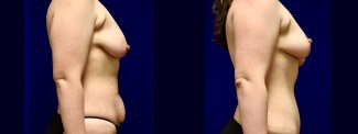 Right Profile View - Breast Lift and Tummy Tuck After Weight Loss