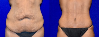 Frontal View - Tummy Tuck After Weight Loss