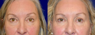 Frontal View - Facelift with Eyelid Surgery