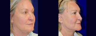 Right 3/4 View - Facelift with Eyelid Surgery