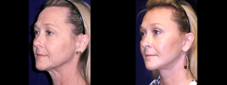 Left 3/4 View - Lower Facelift, Brow Lift and Upper Eyelid Surgery