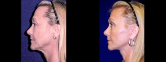 Left Profile View - Lower Facelift, Brow Lift and Upper Eyelid Surgery
