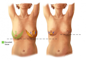Mastopexy