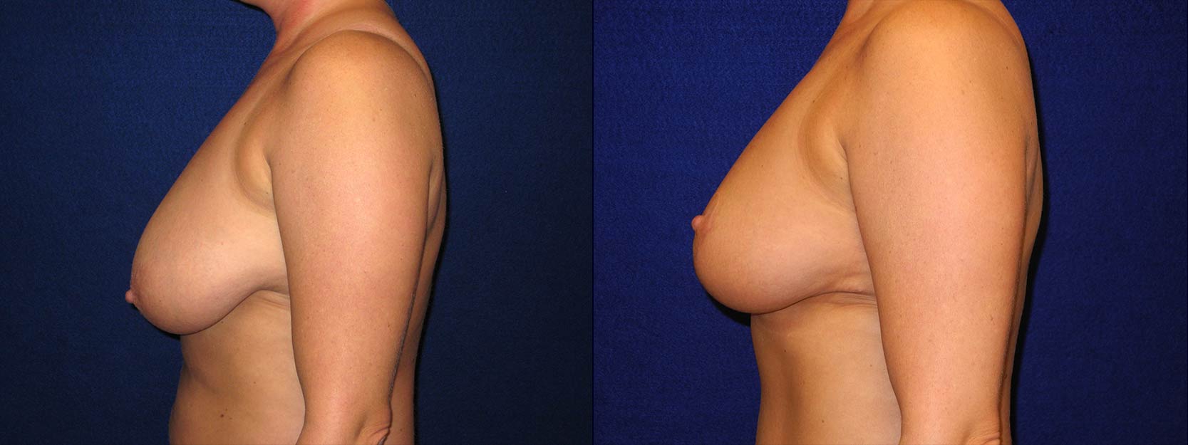 Left Profile View - Breast Reduction