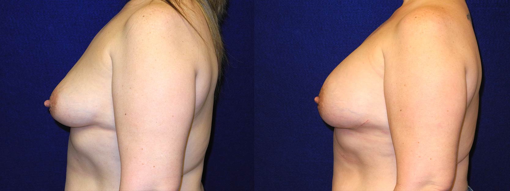 Left Profile View - Breast Reconstruction