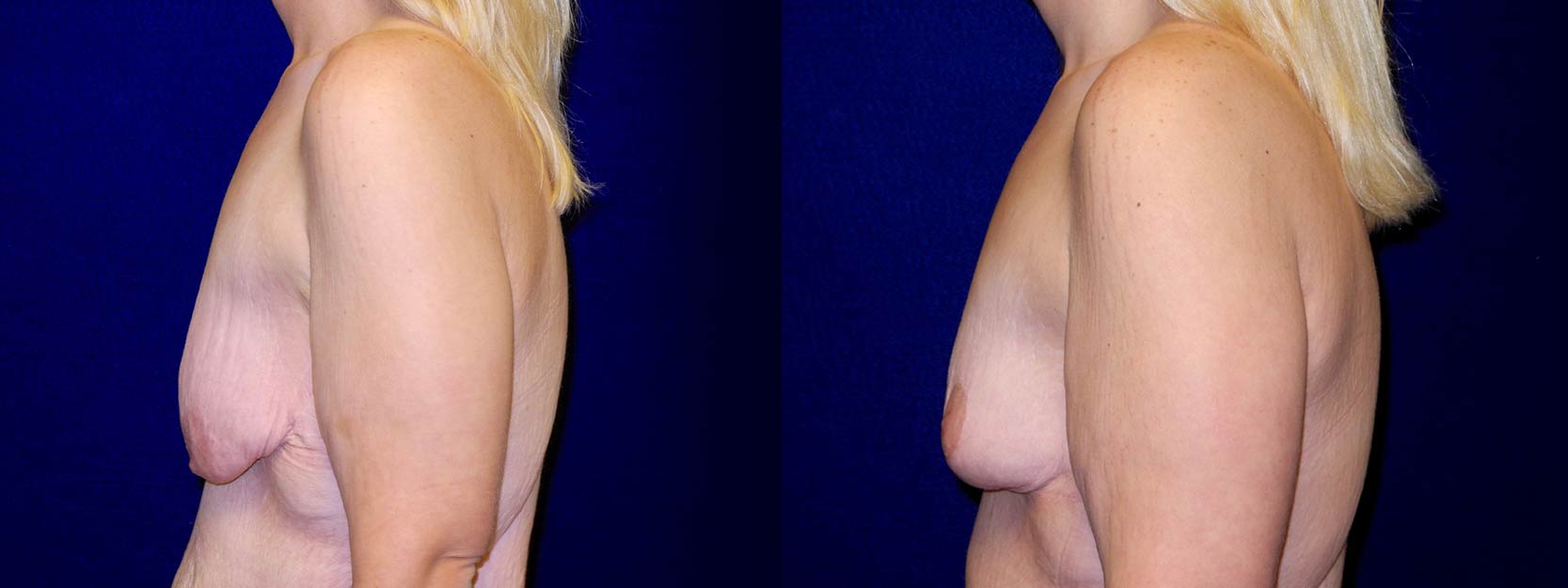 Left Profile View - Breast Lift After Weight Loss