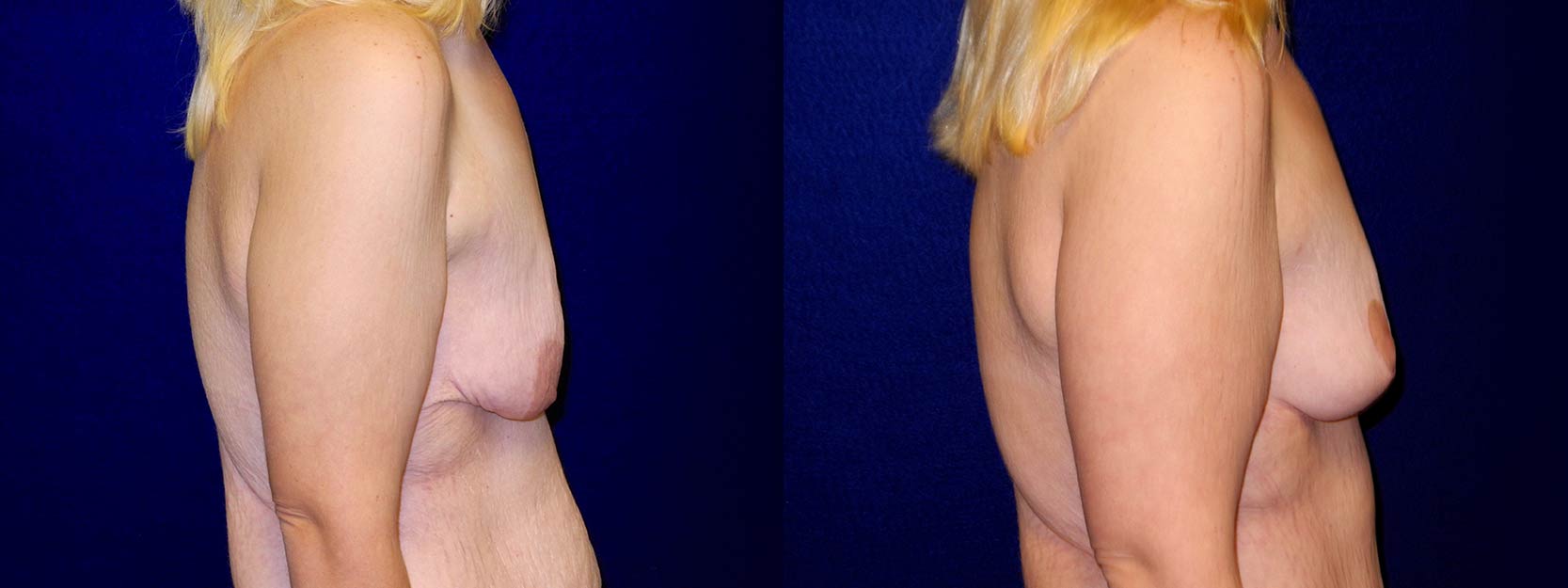 Right Profile View - Breast Lift After Weight Loss