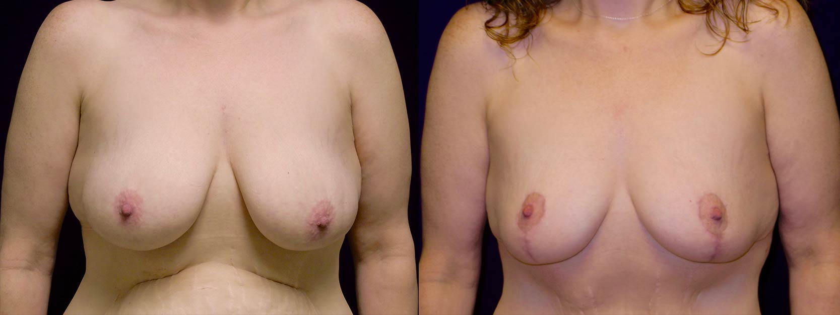 Frontal View - Breast Lift After Weight Loss