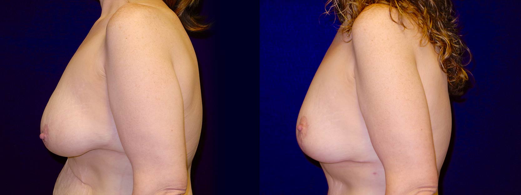 Left Profile View - Breast Lift After Weight Loss