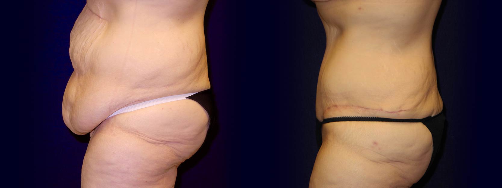 Left Profile View - Tummy Tuck After Weight Loss