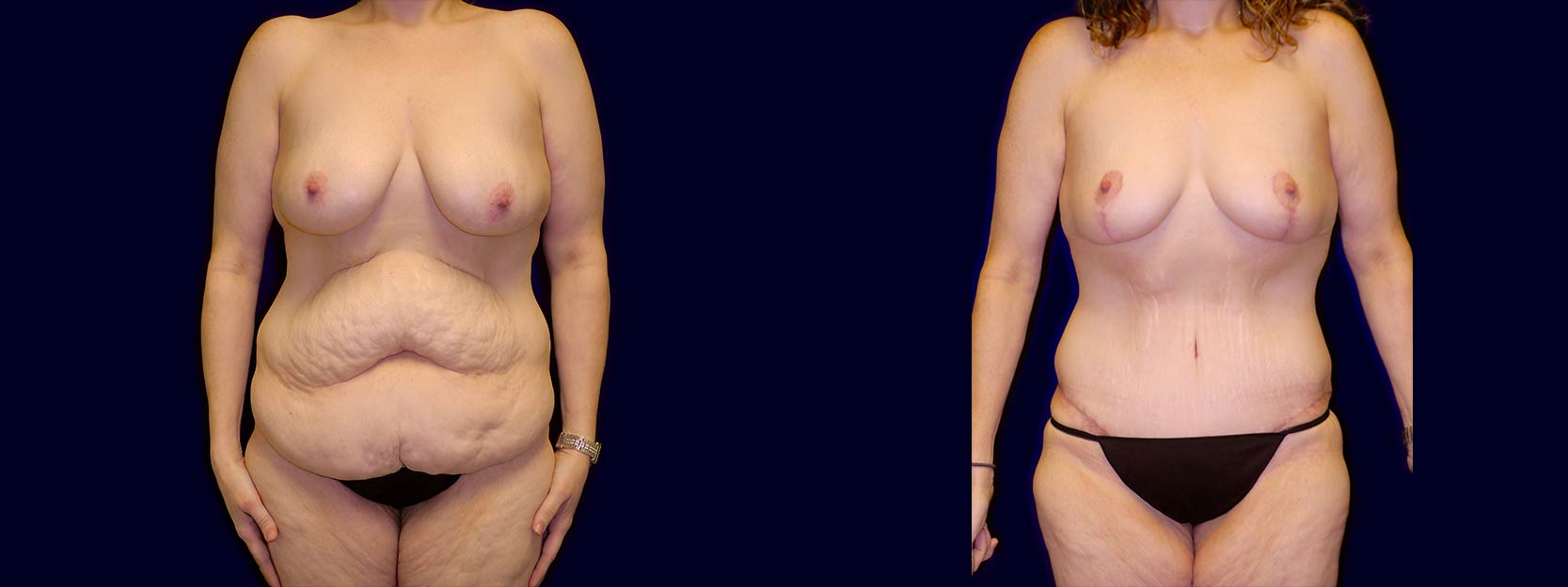 Frontal View - Surgery After Weight Loss - Breast Lift & Tummy Tuck