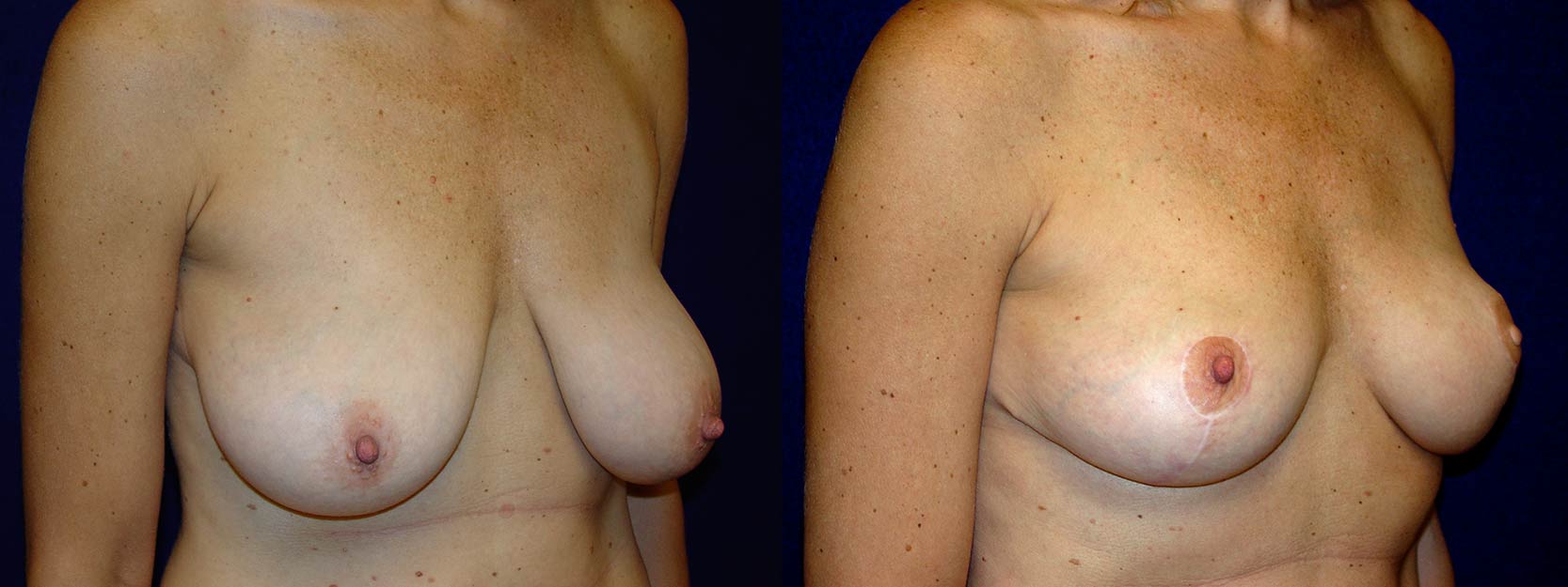 Right 3/4 View - Breast Reconstruction