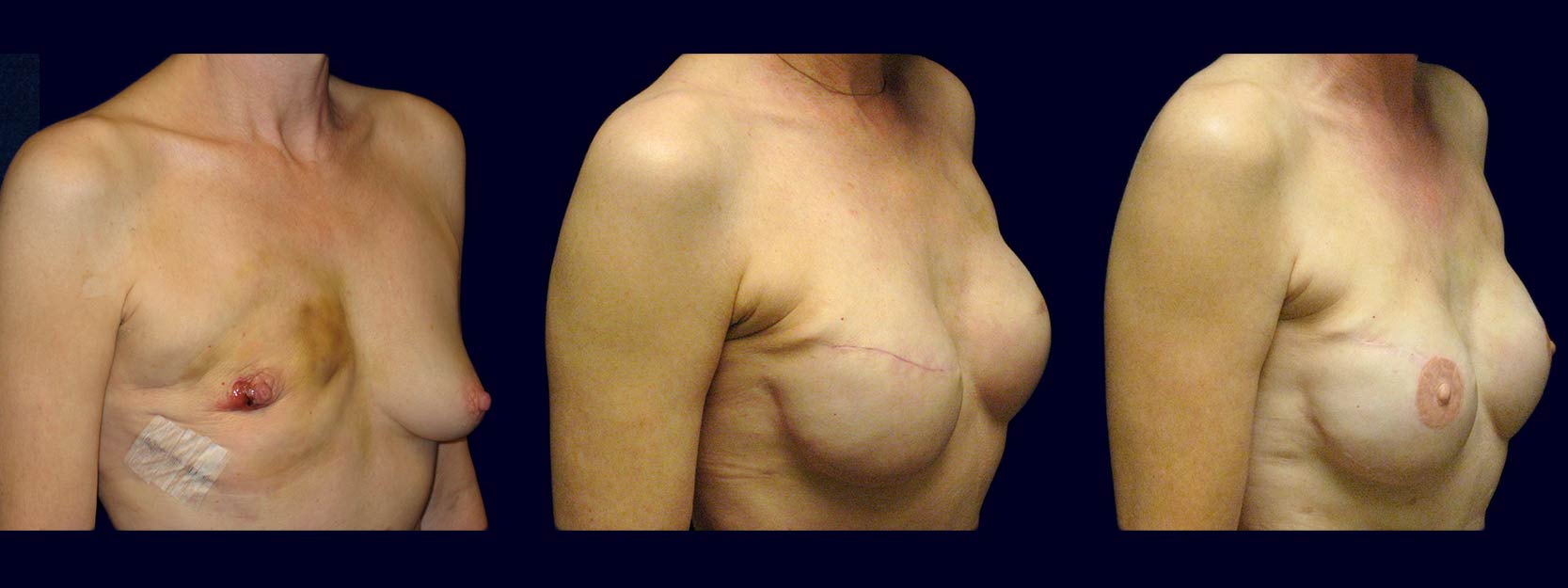 Right 3/4 View - Breast Reconstruction