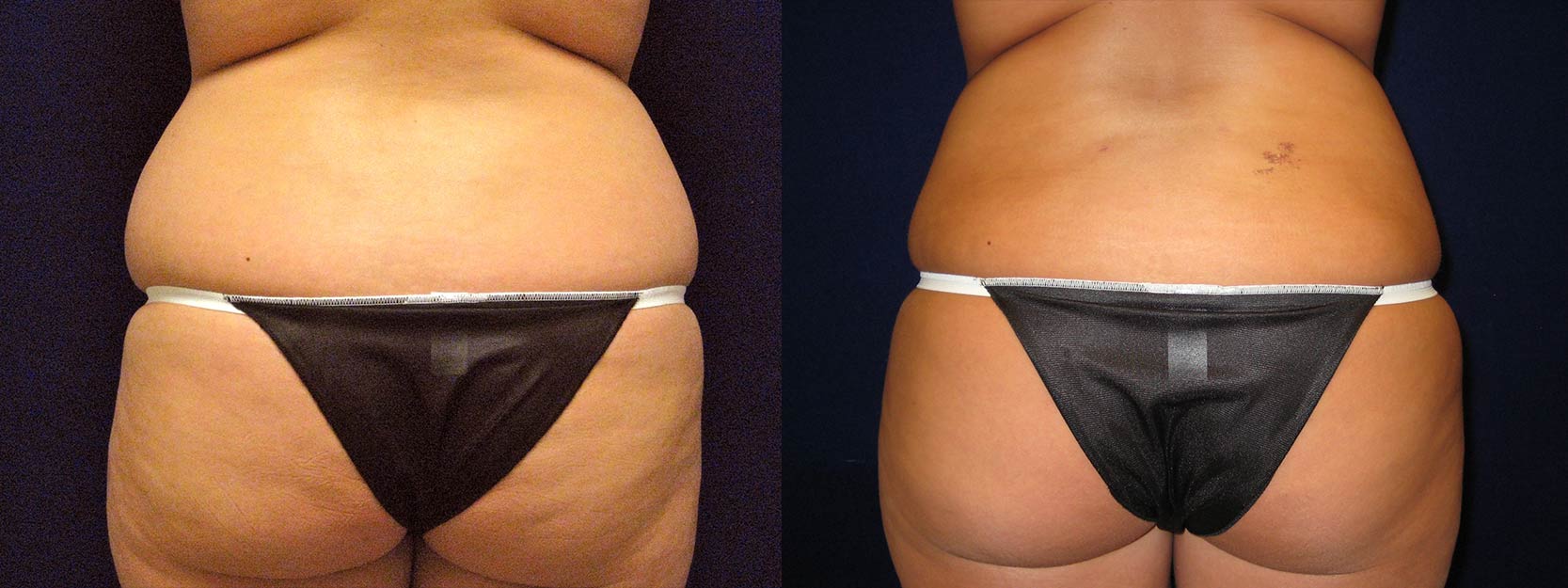 Back View - Liposuction