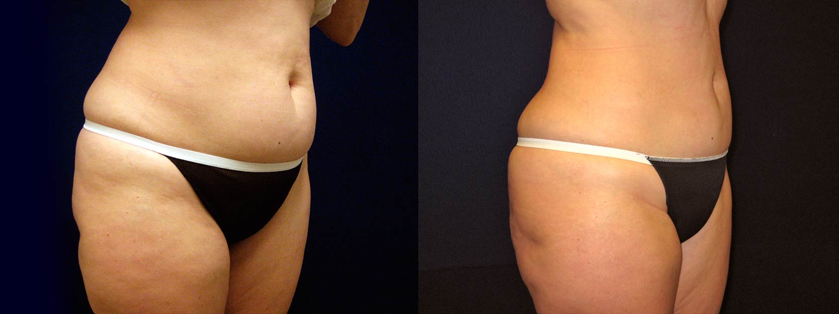 Right 3/4 View - Liposuction