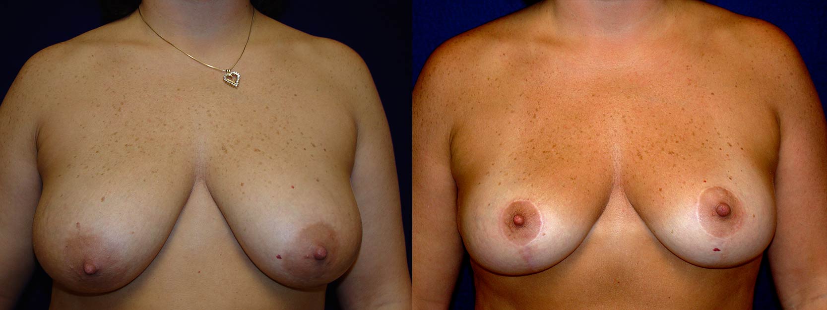 Frontal View -  Breast Lift