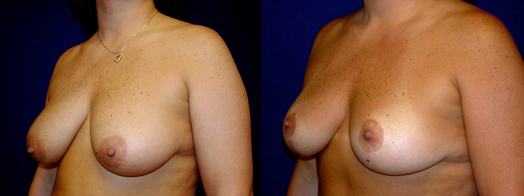 Left 3/4 View - Breast Lift
