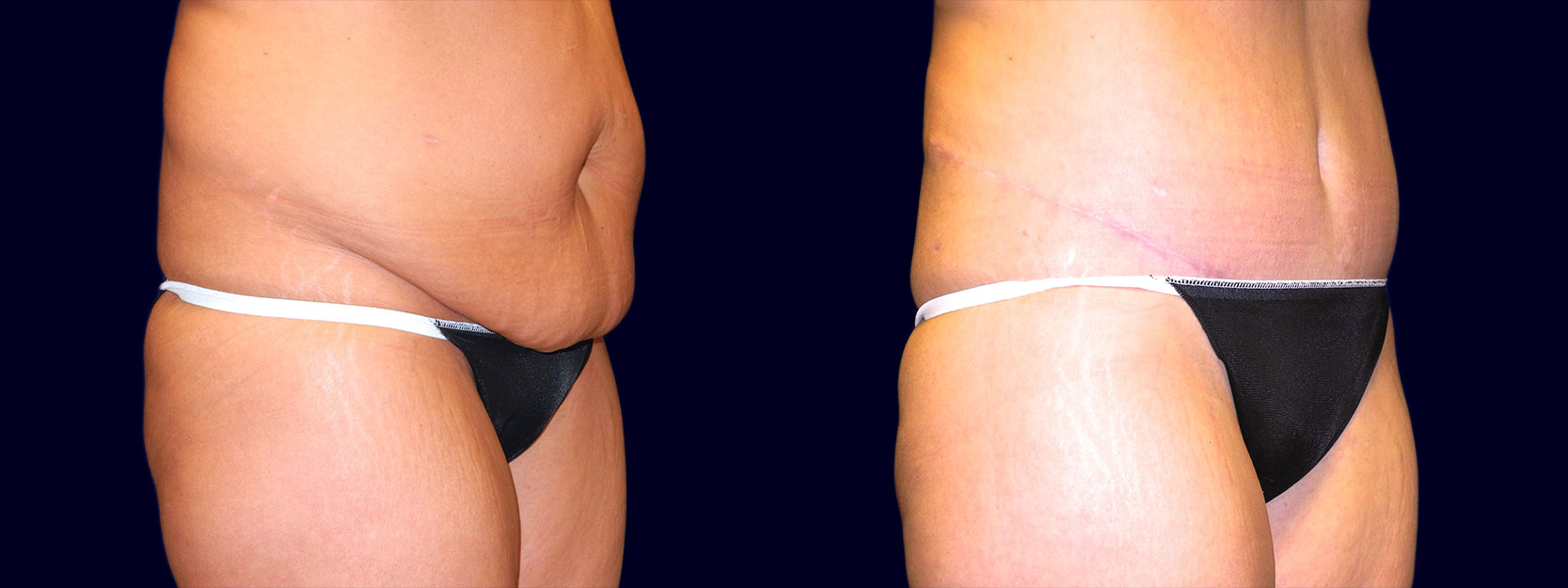 Right 3/4 View - Tummy Tuck After Weight Loss