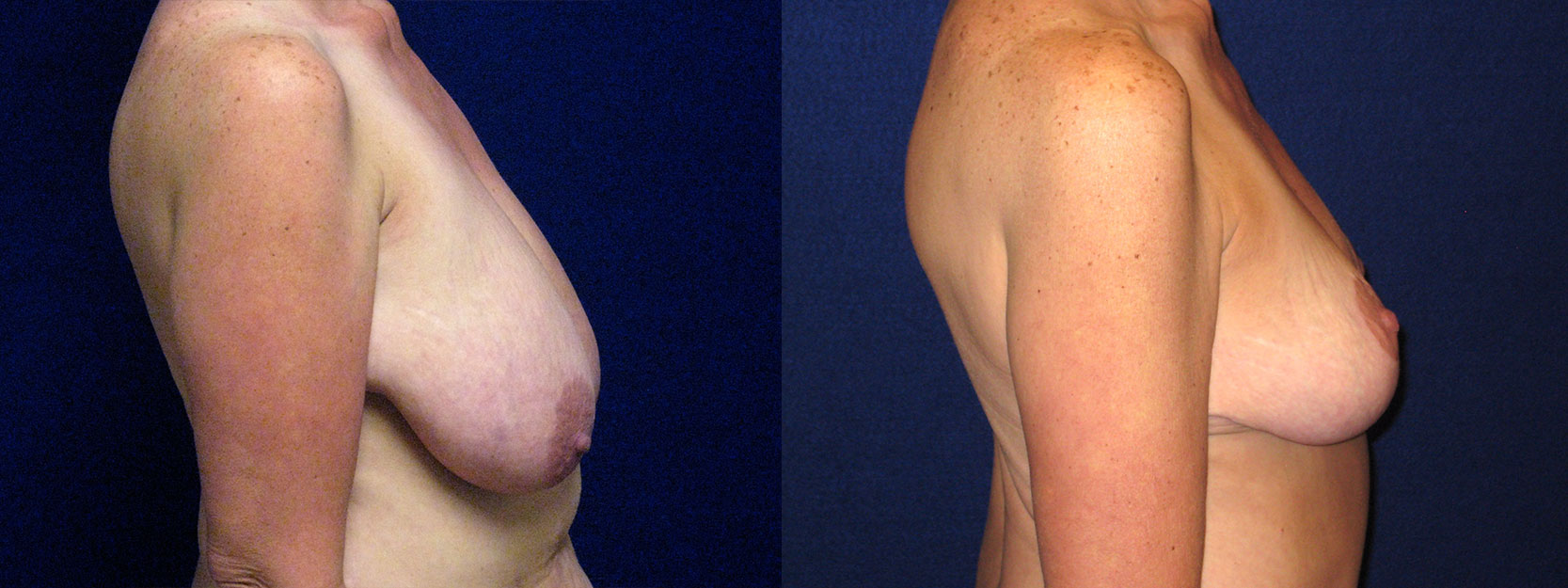 Right Profile View - Breast Lift Reduction