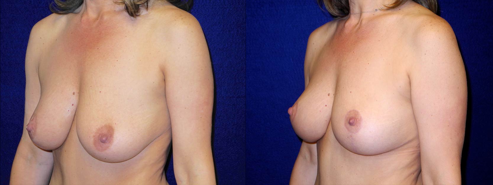 Left 3/4 View - Breast Lift After Pregnancy