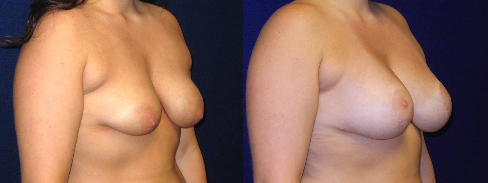 Right 3/4 View - Breast Augmentation with Lift - Silicone Implants