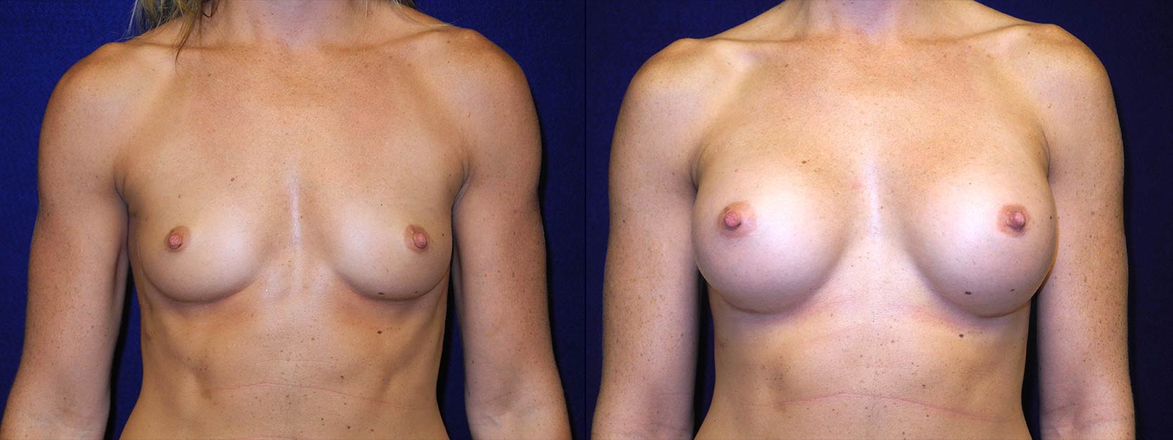 Frontal View - Breast Augmentation - Silicone Implants
