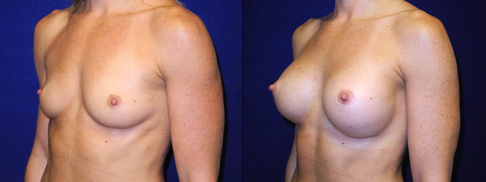 Left 3/4 View - Breast Augmentation - Silicone Implants