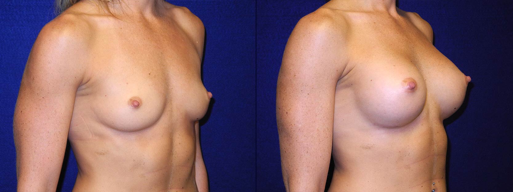Right 3/4 View - Breast Augmentation - Silicone Implants