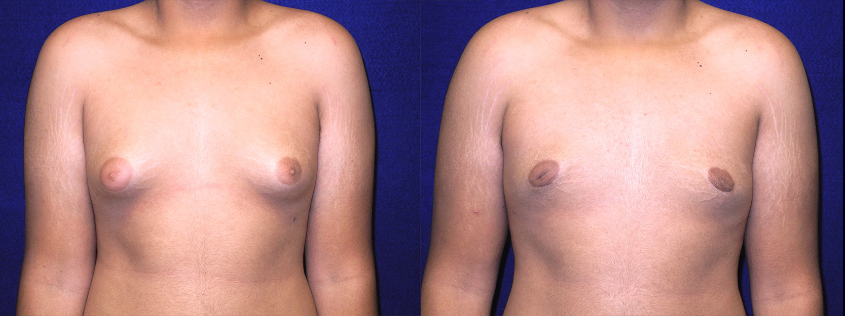 Frontal View - Male Breast Reduction