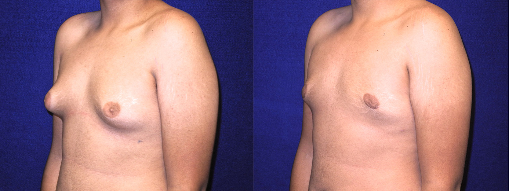 Left 3/4 View - Male Breast Reduction