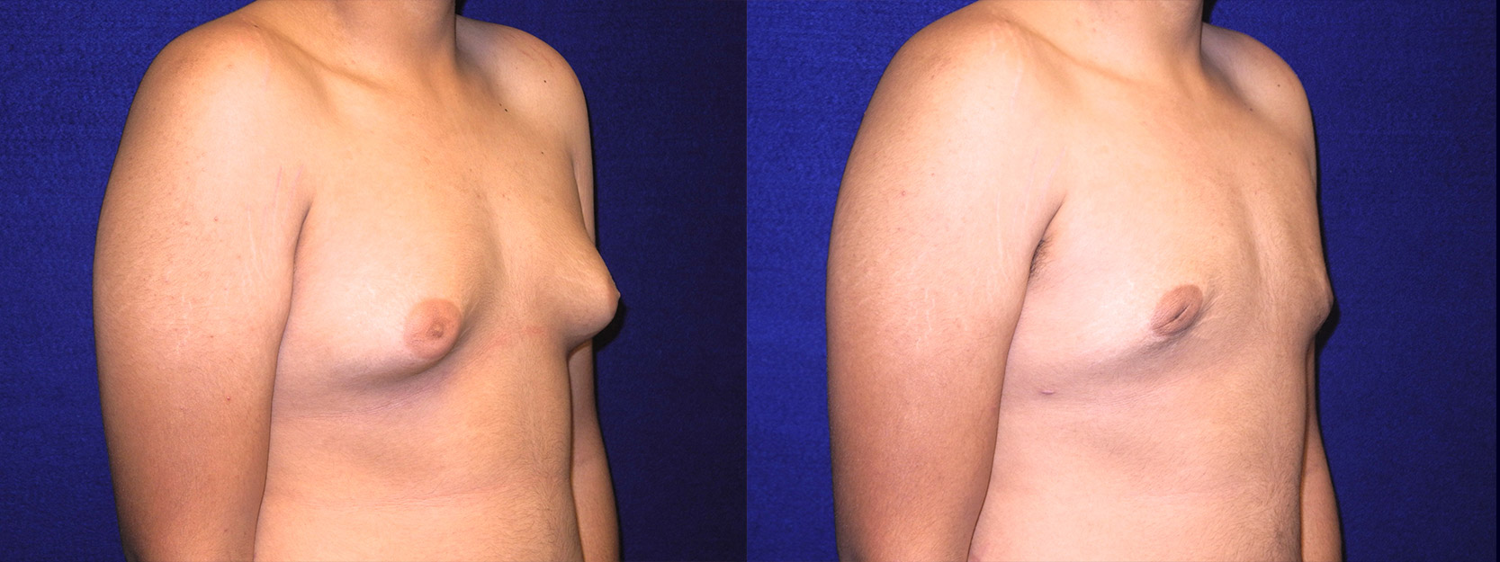 Right 3/4 View - Male Breast Reduction