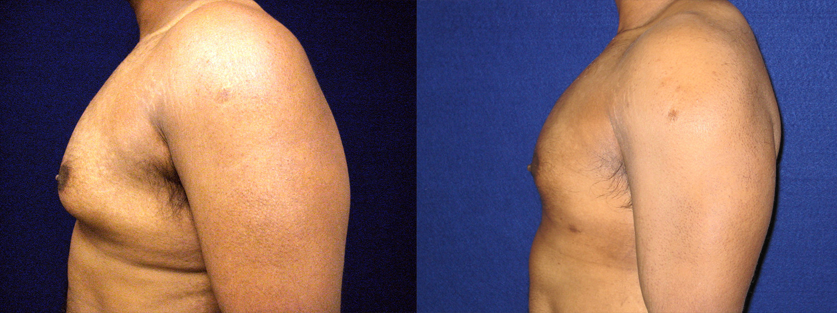 Left Profile View - Male Breast Reduction