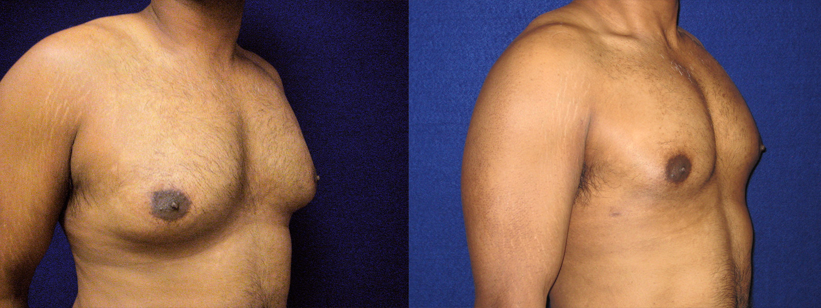 Right 3/4 View - Male Breast Reduction