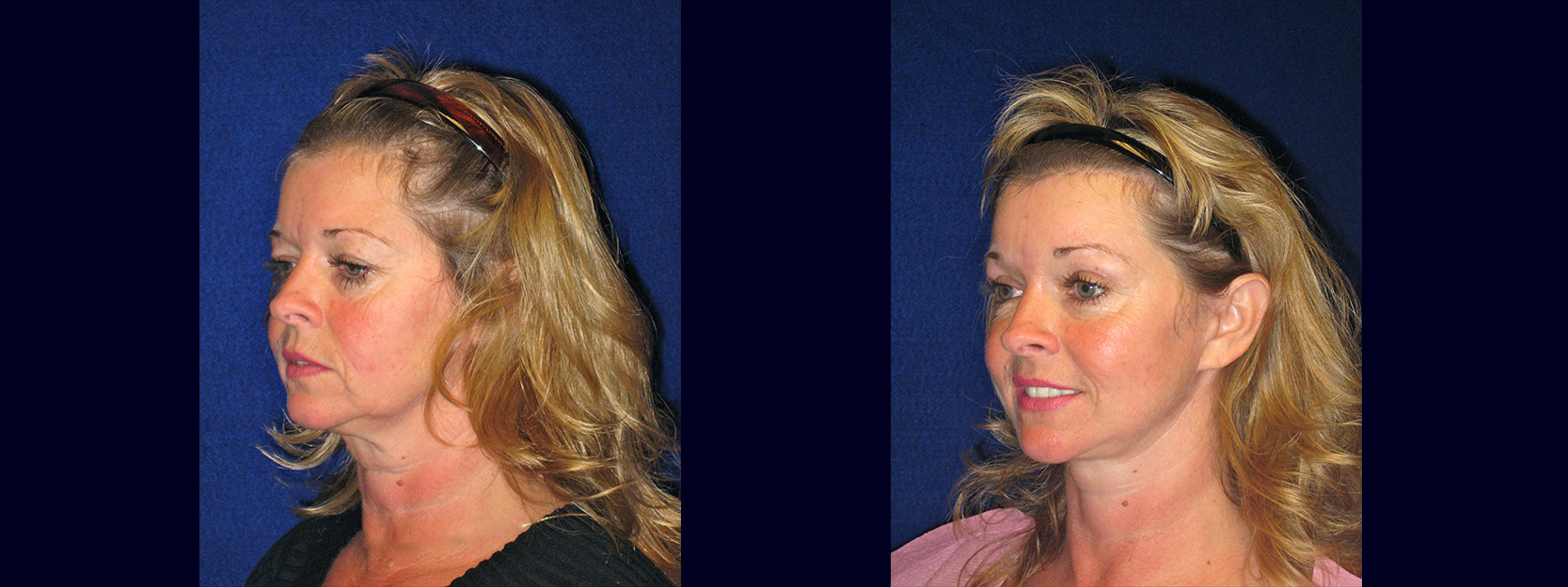 Left 3/4 View - Facelift with Upper and Lower Eyelid Surgery and Browlift