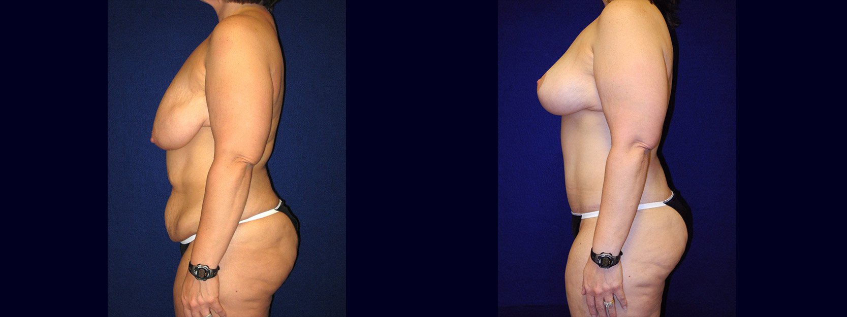 Left Profile View - Body Lift After Massive Weight Loss