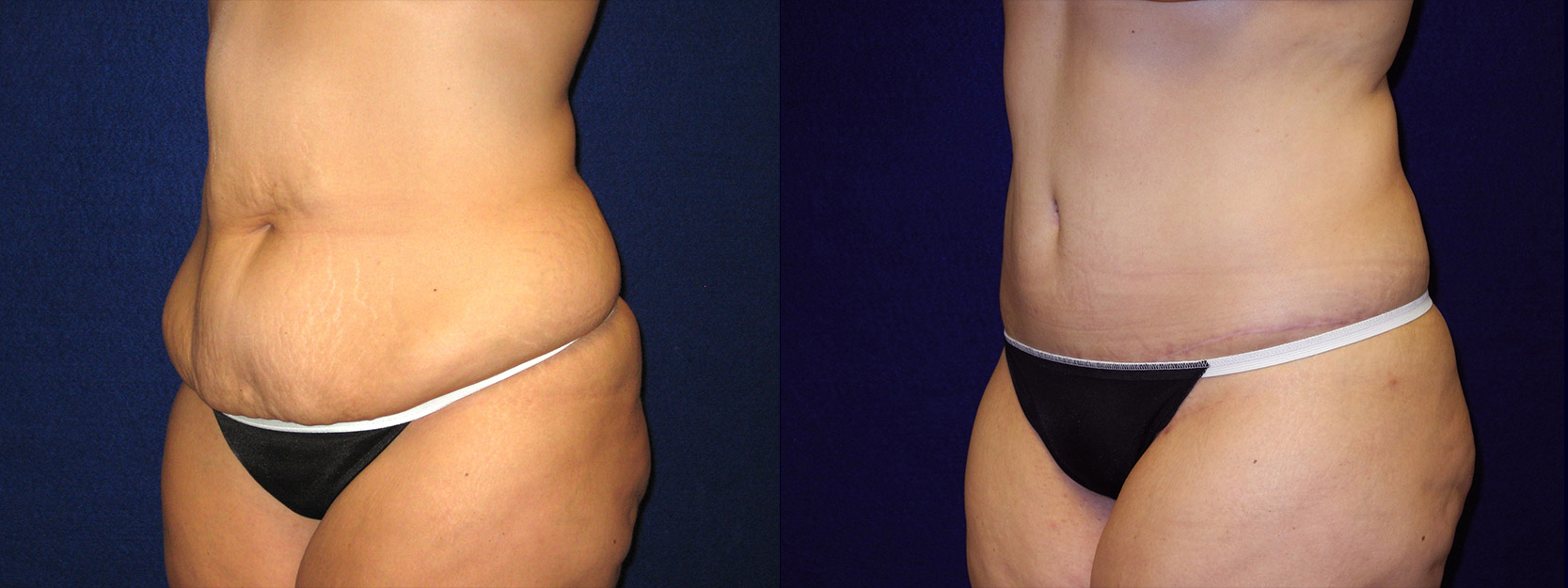 Left 3/4 View - Abdominoplasty After Massive Weight Loss