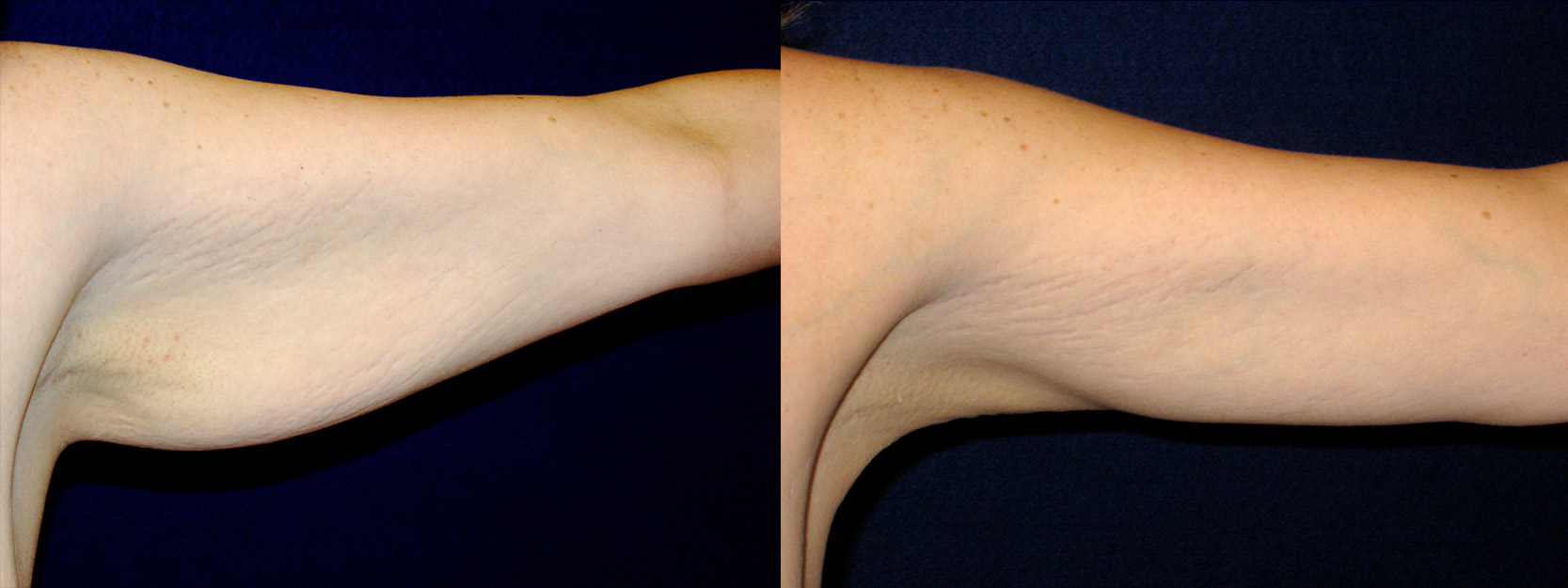 Frontal View - Left Arm - Arm Lift