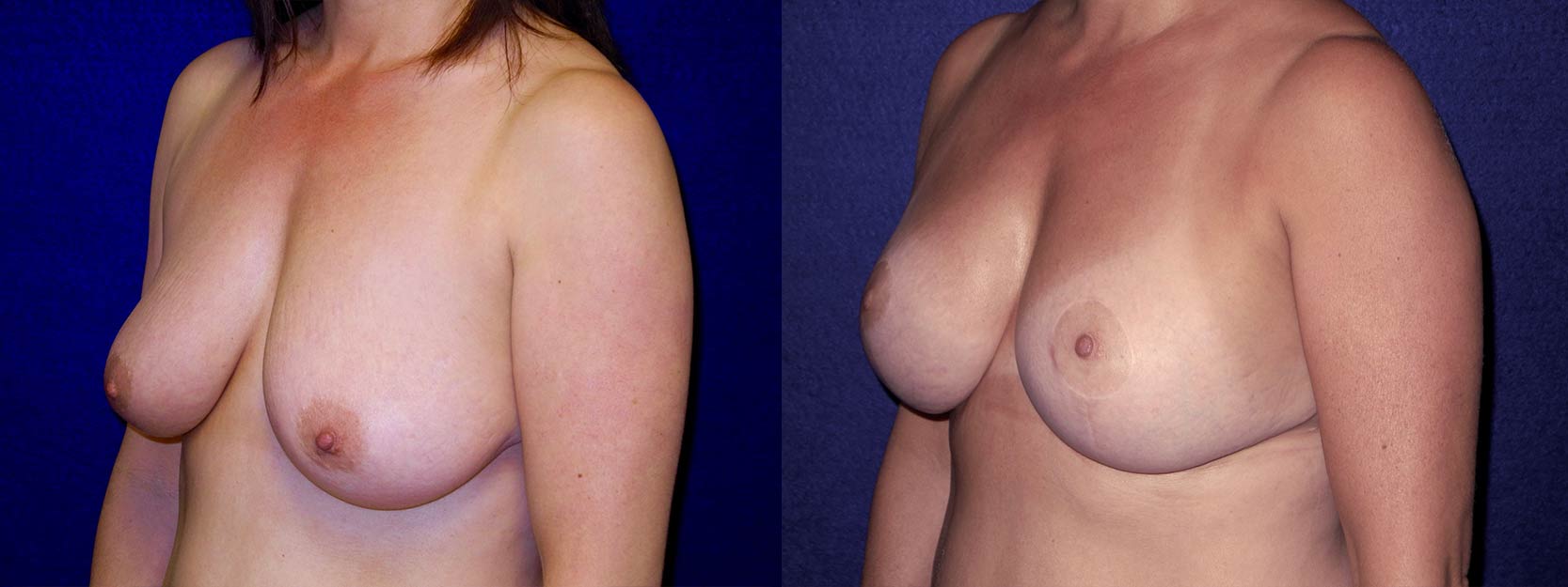 Left 3/4 view - Breast augmentation with Lift