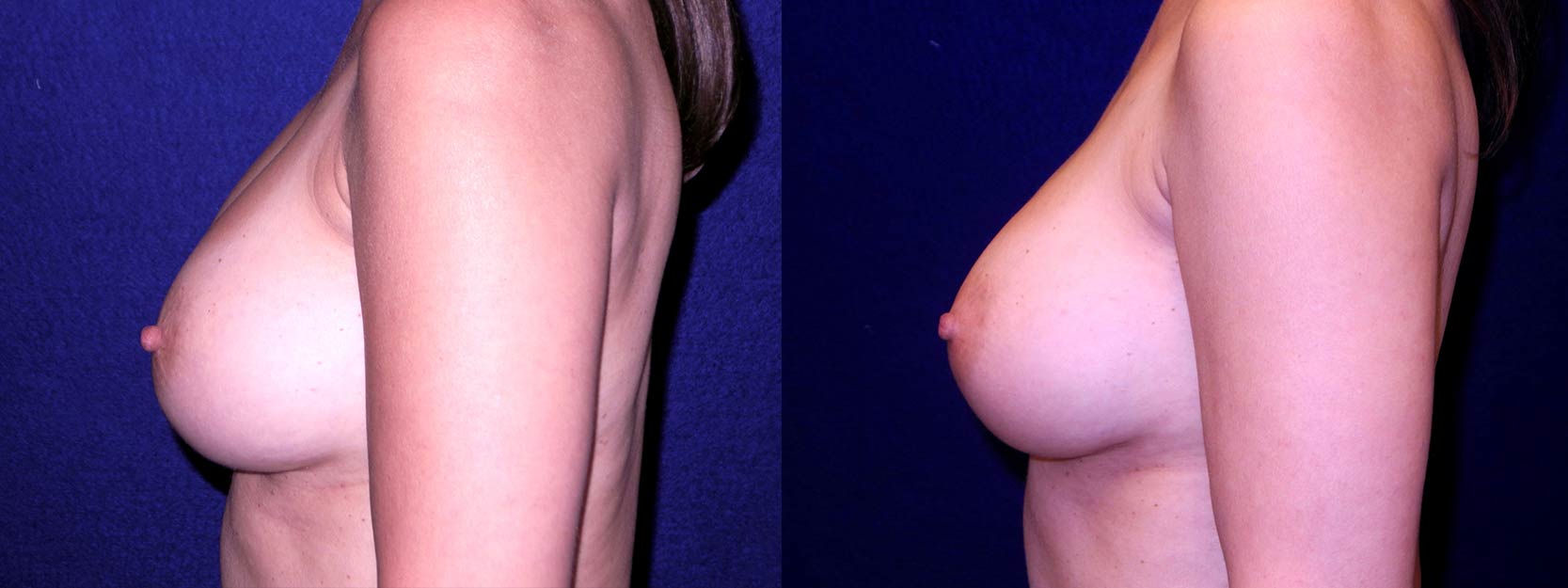 Left Profile View - Implant Revision