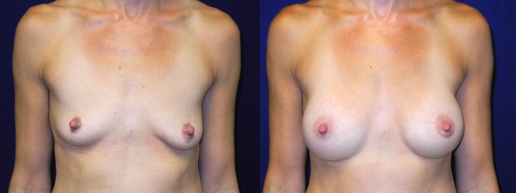 Frontal View - Breast Augmentation with Lift
