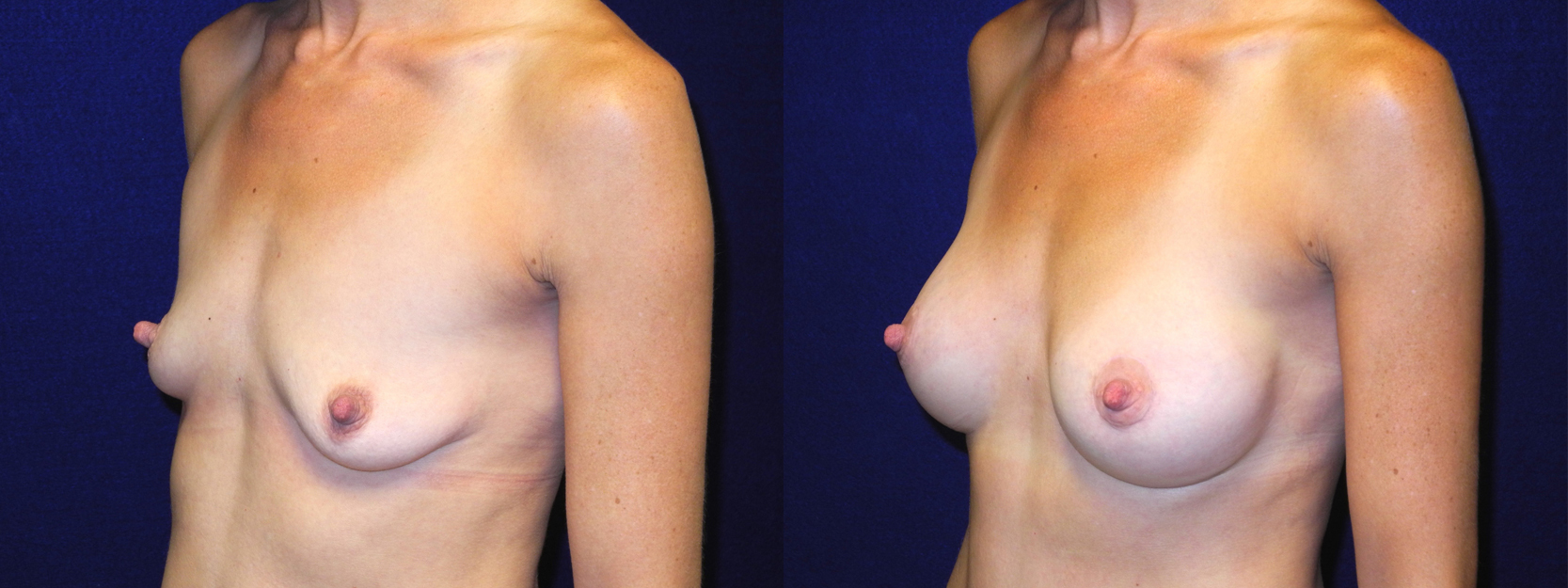 Left 3/4 View - Breast Augmentation with Lift