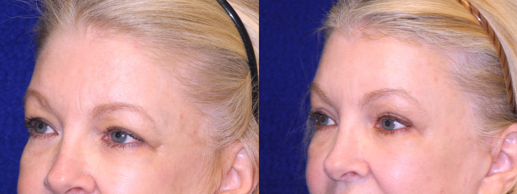 Left 3/4 View Close Up - Facelft, Browlift and Upper Eyelid Surgery