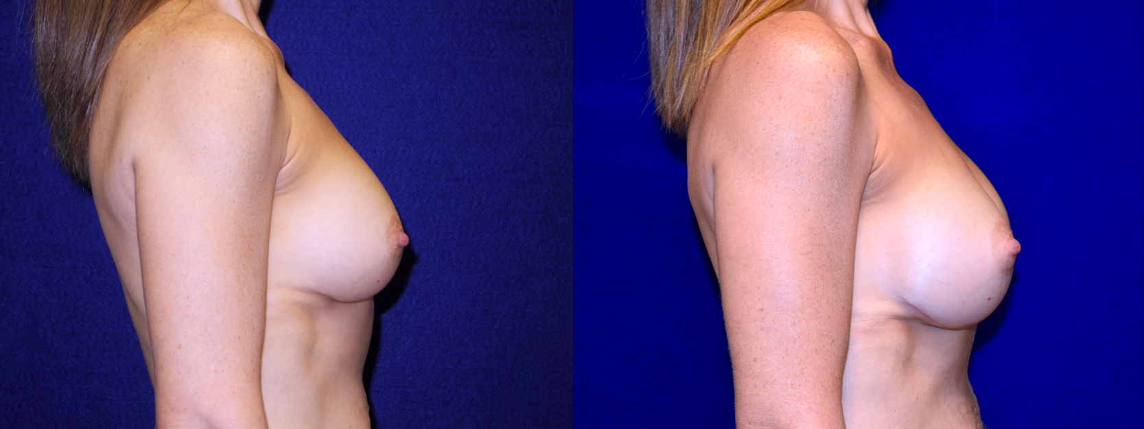 Right Profile View - Breast Implant Revision