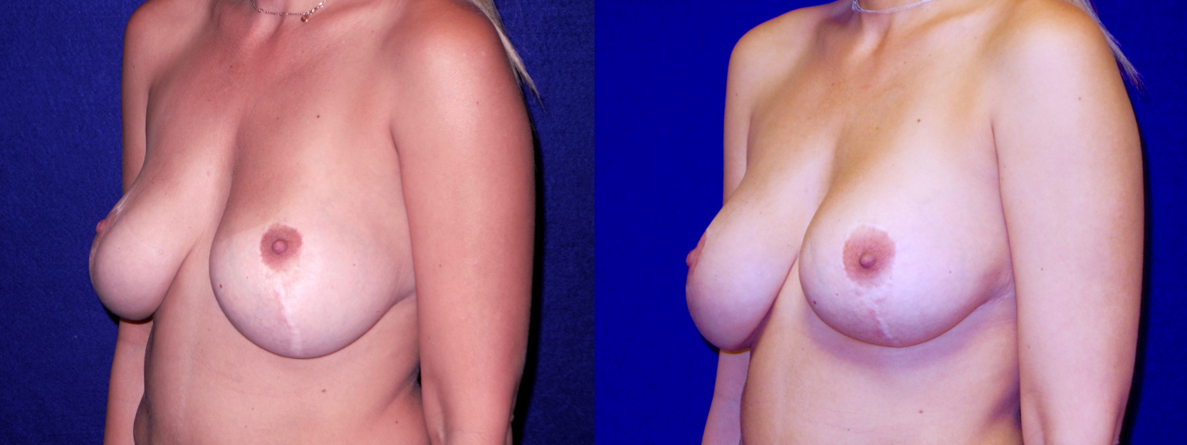 Left 3/4 View - Breast Implant Revision