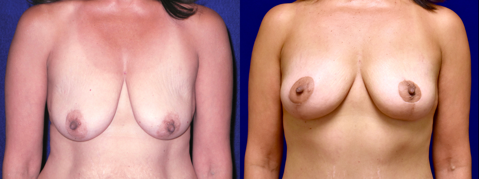 Frontal View - Breast Lift